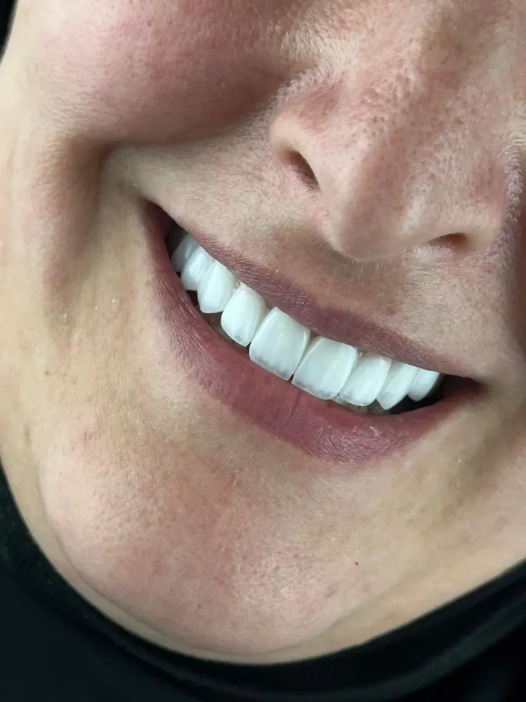 Hollywood Smile in Amman: Everything You Need to Know