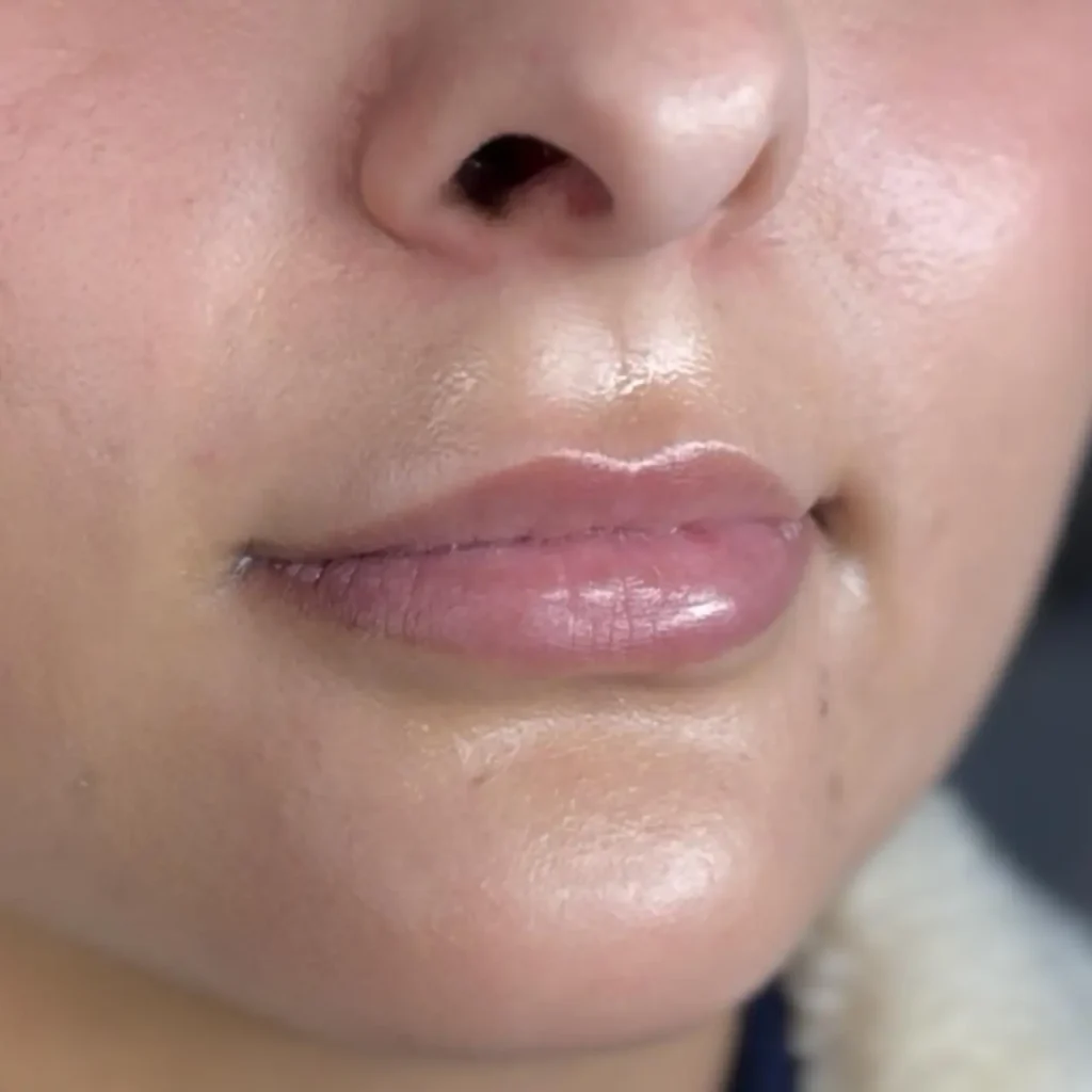 Botox & Fillers in Dental Clinics: A Modern Approach to Aesthetics